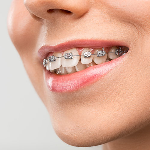 Ortodontik tedaviler ne kadar sürer?
