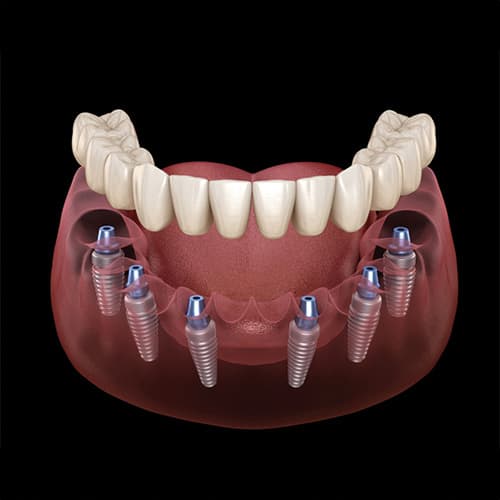 Dişsiz Hastalarda Sağlam ve  Konforlu Diş Çözümleri Nelerdir?