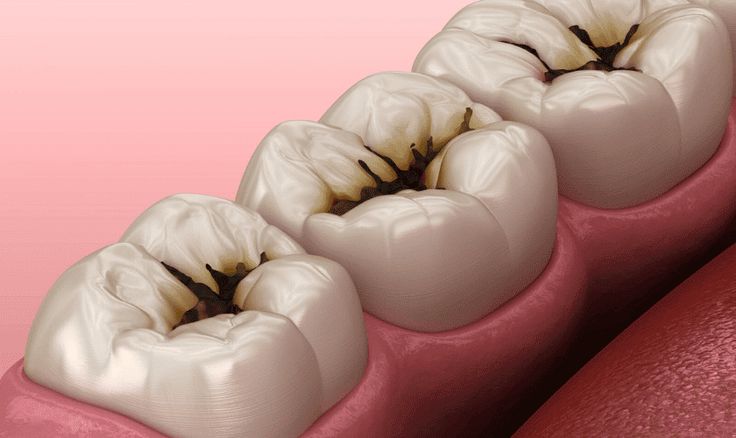 50- Diş Çürüklerinin Belirtileri ve Tanıları: Günlük Bakımda Önemli Bir Adım
