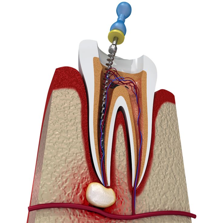 52- Kanal Tedavili Dişlerde Hassasiyet: Nedenleri, Tedavisi