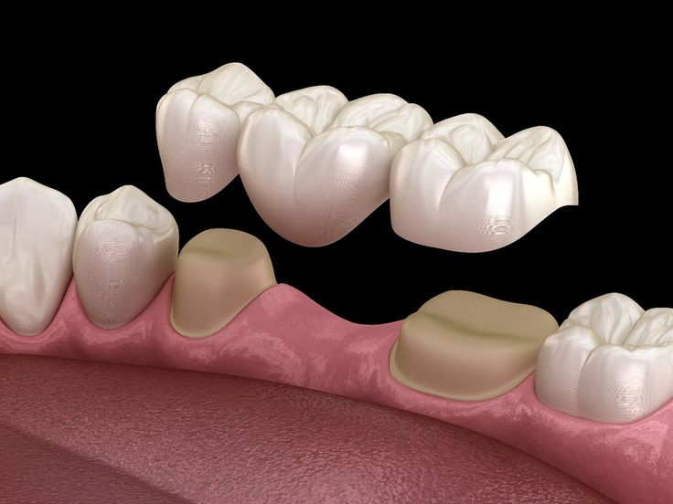 53- Köprü Dişlerde Sallanma: Nedenleri, Belirtileri
