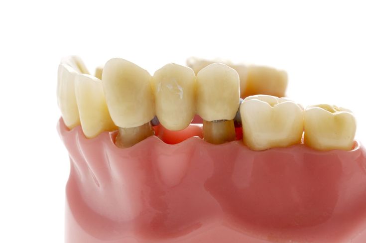 54- Köprü Altında Diş Eti Çekilmesi: Nedenleri ve Tedavi Seçenekleri