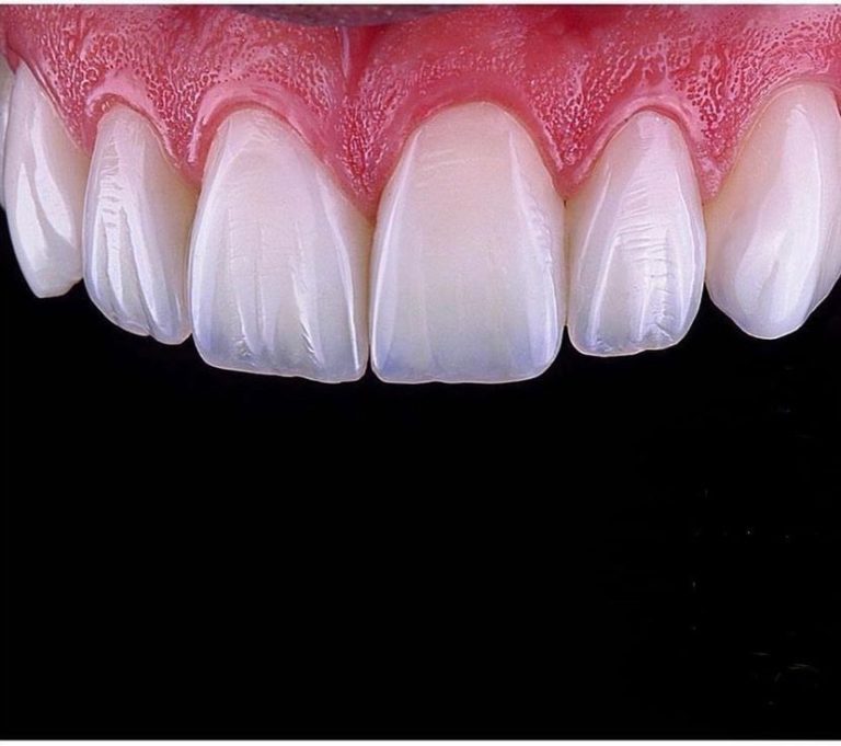 61-Zirkonyum Dişler: Estetik Görünüm ve Dayanıklılığın Mükemmel Bir Birleşimi