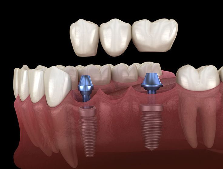 62-İmplantlar mı Köprüler mi? Diş Eksikliğinde En Uygun Tedavi Seçeneği Nasıl Belirlenir?
