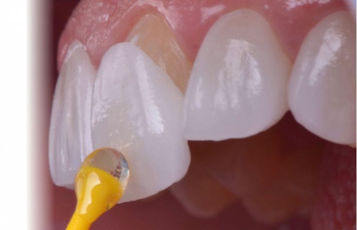 62-İmplantlar mı Köprüler mi? Diş Eksikliğinde En Uygun Tedavi Seçeneği Nasıl Belirlenir?