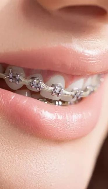 6- Ortodonti Sonrası Çapraşıklık Geri Döner mi?