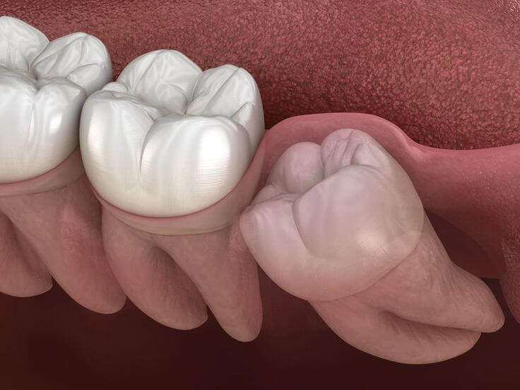 12 -Gömülü Diş Çekimi Sonrası Dikkat Edilmesi Gerekenler