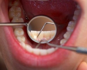17- Diş Taşları: Oluşum Nedenleri ve Önleme Yolları