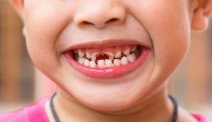 23-Çocuklarda Diş Çürümesini Önlemenin Yolları