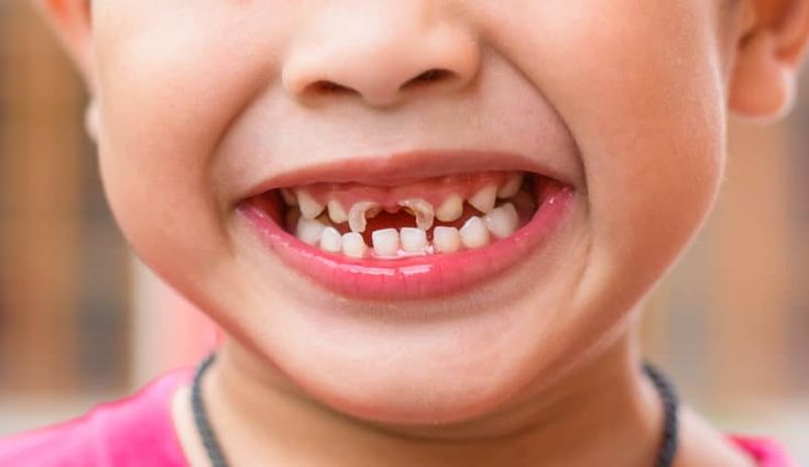 24-Çocuklarda Diş Çürümesini Önlemenin Yolları
