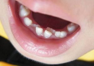 44-Çocuğunuzun Süt Dişleri Erken Çekildiyse