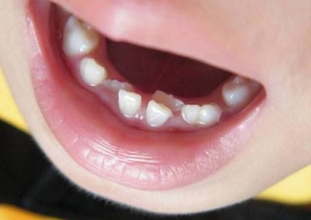 44- Çocuğunuzun Süt Dişleri Erken Çekildiyse Ne Yapmalı?